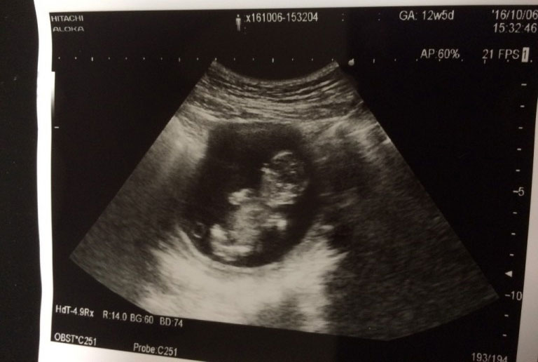 妊娠4ヶ月の超音波写真