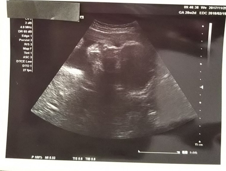 妊娠7ヶ月の超音波写真