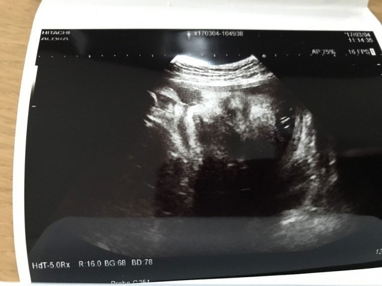 妊娠9ヶ月の超音波写真