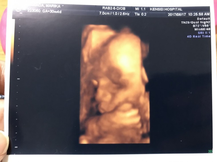 妊娠8ヶ月の超音波写真