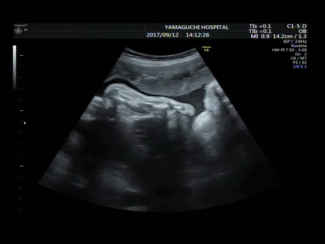 妊娠10ヶ月の超音波写真