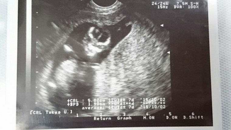 妊娠4ヶ月の超音波写真