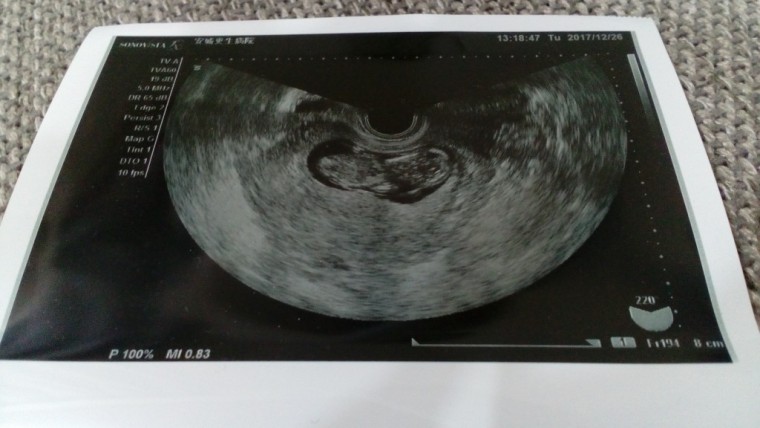 妊娠3ヶ月の超音波写真