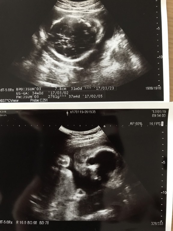 妊娠8ヶ月の超音波写真
