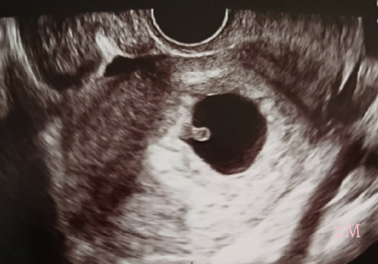 妊娠2ヶ月の超音波写真