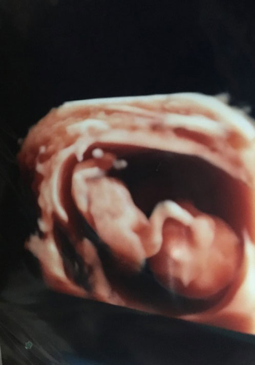 妊娠5ヶ月の超音波写真