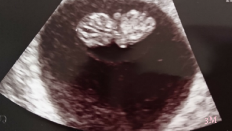 妊娠3ヶ月の超音波写真