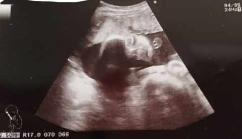 妊娠7ヶ月の超音波写真