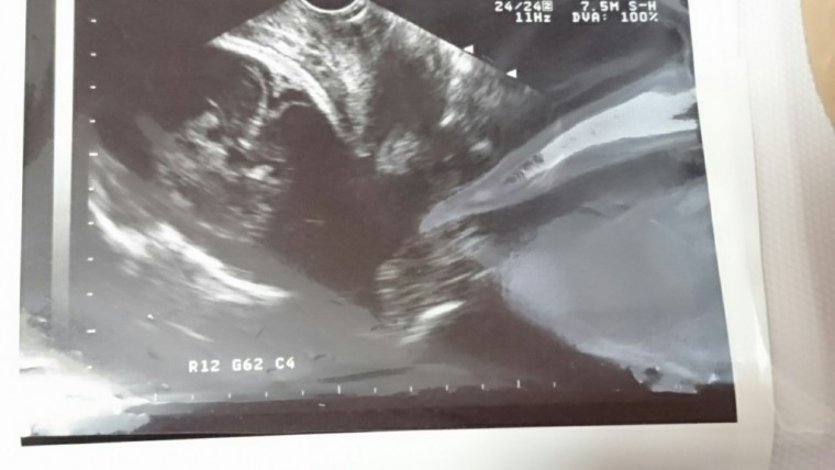妊娠10ヶ月の超音波写真