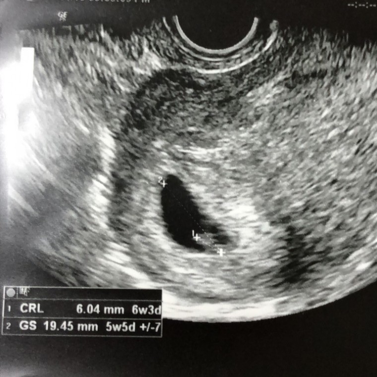 妊娠2ヶ月の超音波写真
