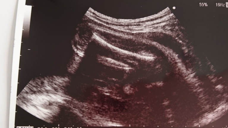 妊娠9ヶ月の超音波写真