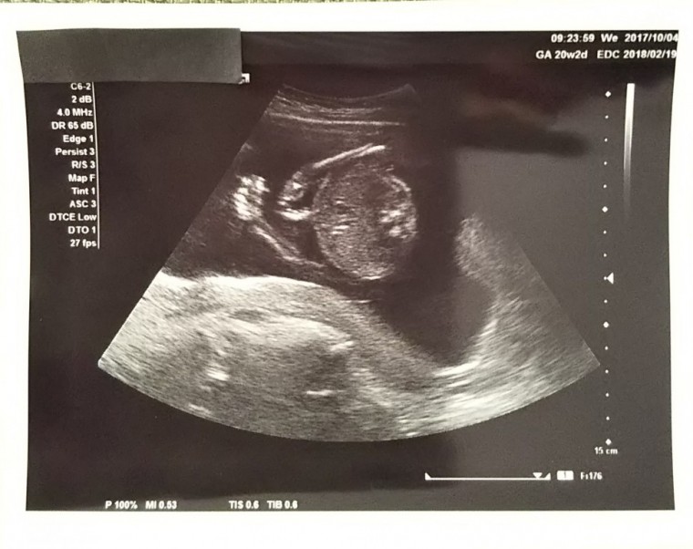 妊娠6ヶ月の超音波写真