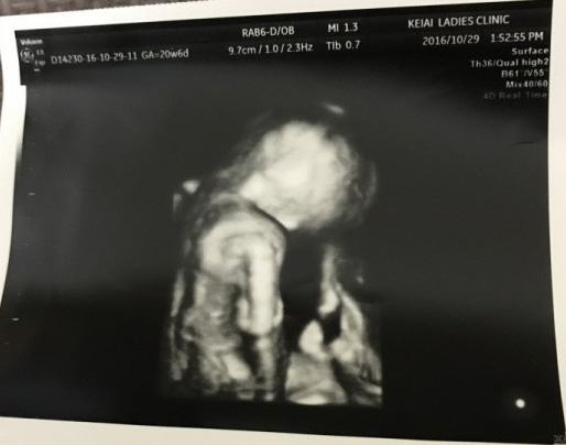 妊娠6ヶ月の超音波写真