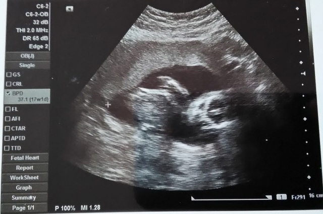 妊娠5ヶ月の超音波写真